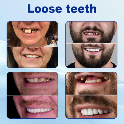 [Official Brand Store] Seurico™ Advanced Customized Full Denture Set - ⏰🔥Limited Time Only: Get 50% Off Now!