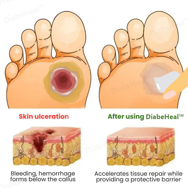 DiabeHeal™ Diabetic Skin Healing Cream 🌿