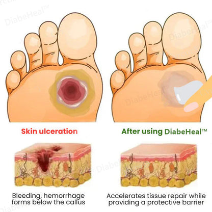DiabeHeal™ Diabetic Skin Healing Cream 🌿