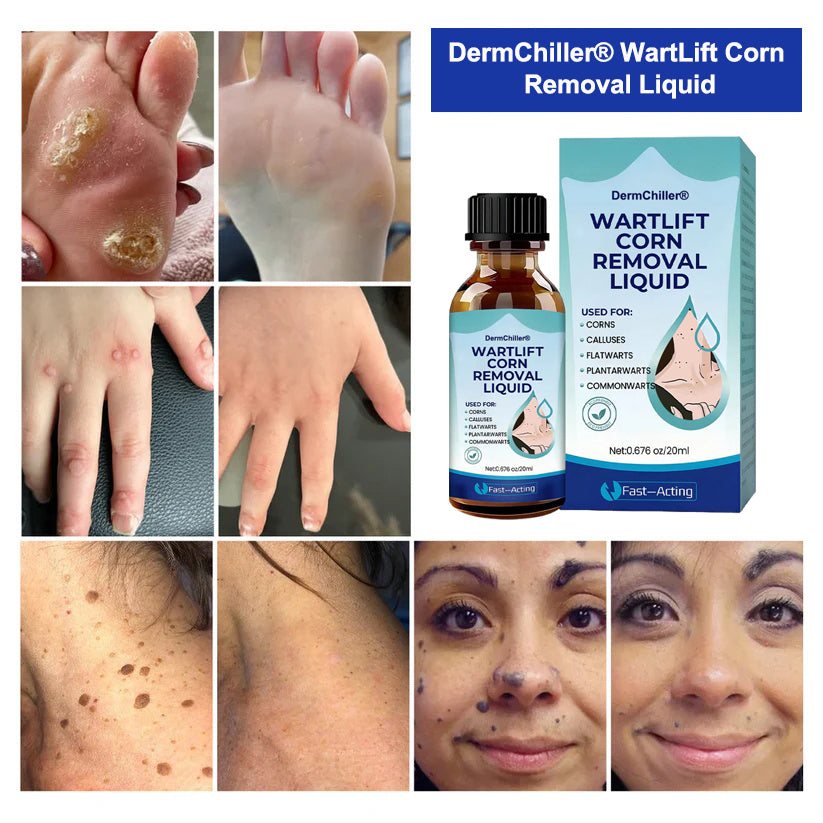 DermChiller® Clinically-Inspired Wart & Corn Removal — Precision Renewal You Can Trust🎁