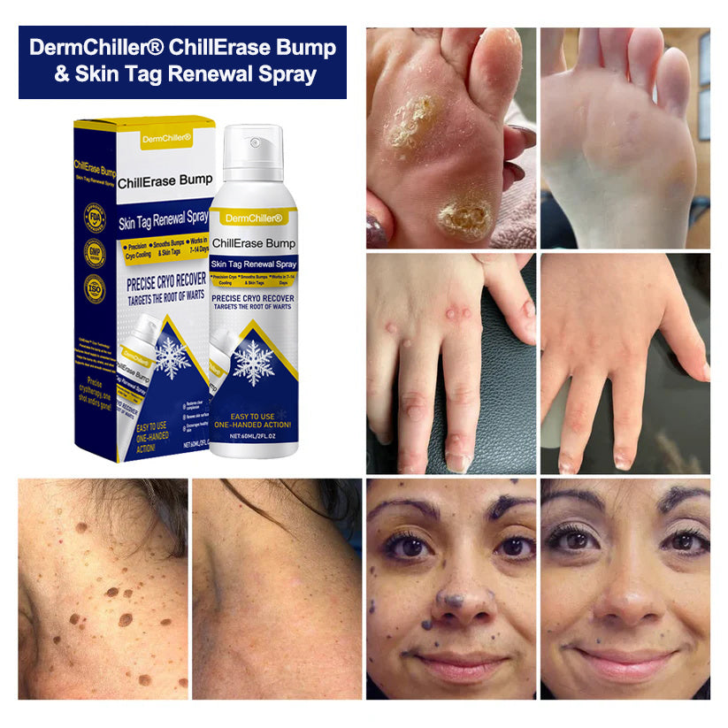 DermChiller® ChillErase Bump & Skin Tag Renewal Spray