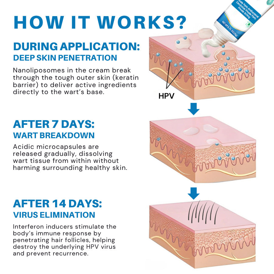 Vironexil® Clinical HPV Wart Therapy Cream for Men (Advanced Nanoliposome Delivery + Immune Activation for Root-Level HPV Wart Elimination)