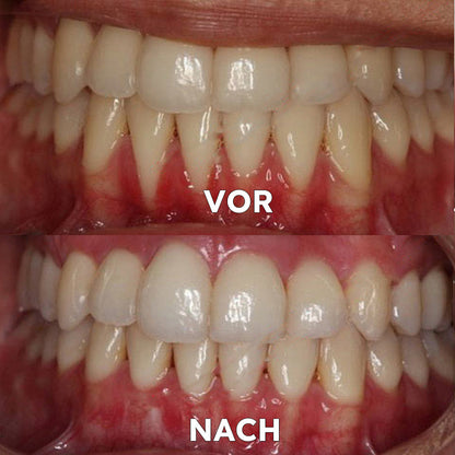 ✅Seurico™ Zahnfleischreparatur & Mundgesundheits-Pulver (CE-zertifiziert für Parodontitis, Mundgeschwüre und Zahnfleischrückgang)