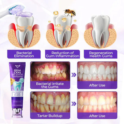 BeeLumine® BeeRenew — Clinically Advanced Regenerative Gum Therapy（2）